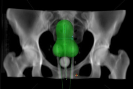 Braquiterapia Ginecológica 3D