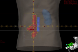 Radioterapia Conformacional 3D